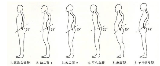 骨の歪み